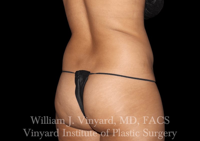 Liposuction Before & After Gallery - Patient 169753790 - Image 3