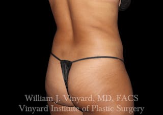 Liposuction Before & After Gallery - Patient 169753790 - Image 4