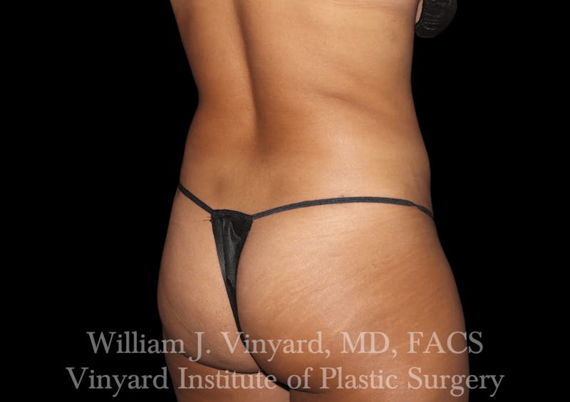 Liposuction Before & After Gallery - Patient 169753790 - Image 4