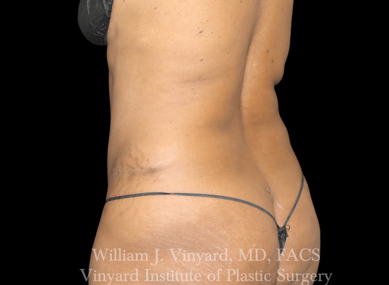 Liposuction Before & After Gallery - Patient 169753796 - Image 3