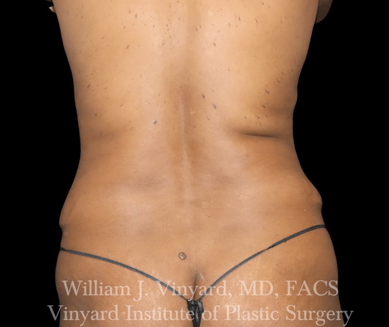 Liposuction Before & After Gallery - Patient 169753796 - Image 1