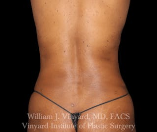Liposuction Before & After Gallery - Patient 169753796 - Image 2