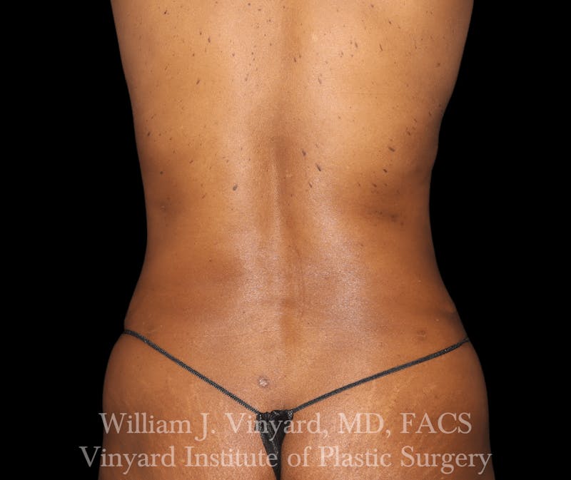 Liposuction Before & After Gallery - Patient 169753796 - Image 2