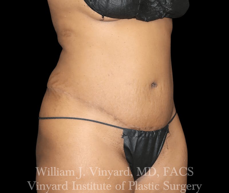 Liposuction Before & After Gallery - Patient 169753796 - Image 5
