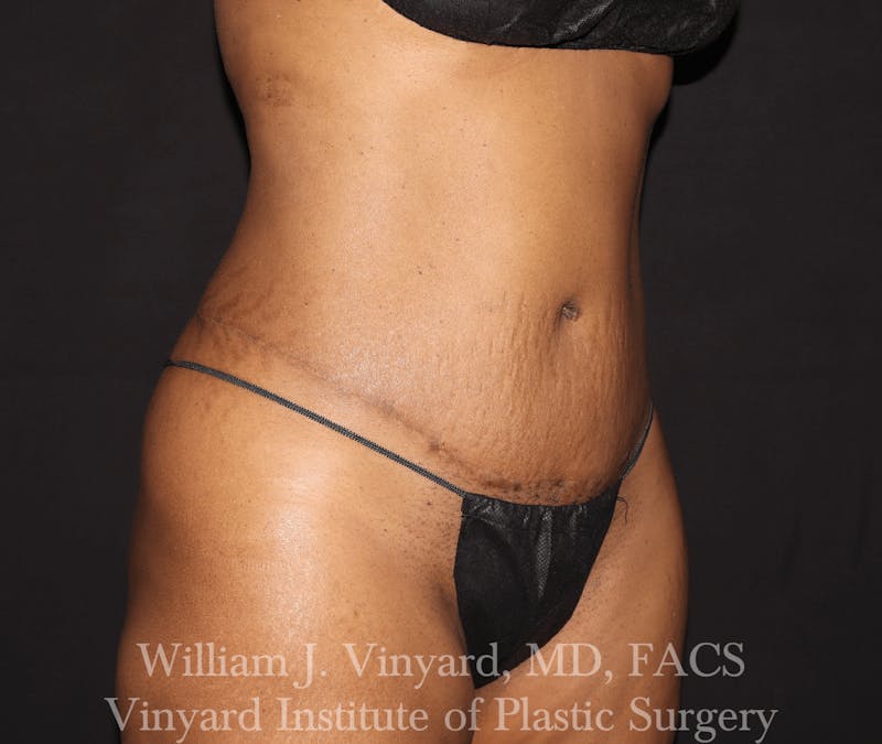 Liposuction Before & After Gallery - Patient 169753796 - Image 6