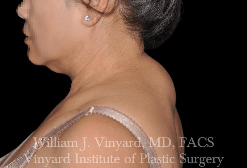 Liposuction Before & After Gallery - Patient 169754035 - Image 1