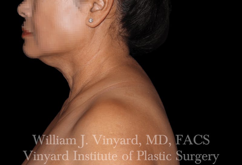 Liposuction Before & After Gallery - Patient 169754035 - Image 2