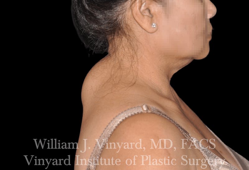 Liposuction Before & After Gallery - Patient 169754035 - Image 3