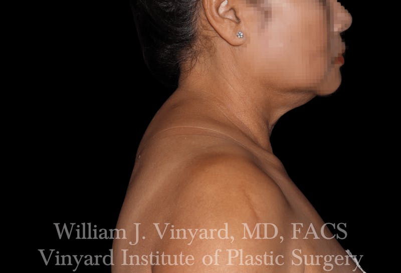 Liposuction Before & After Gallery - Patient 169754035 - Image 4