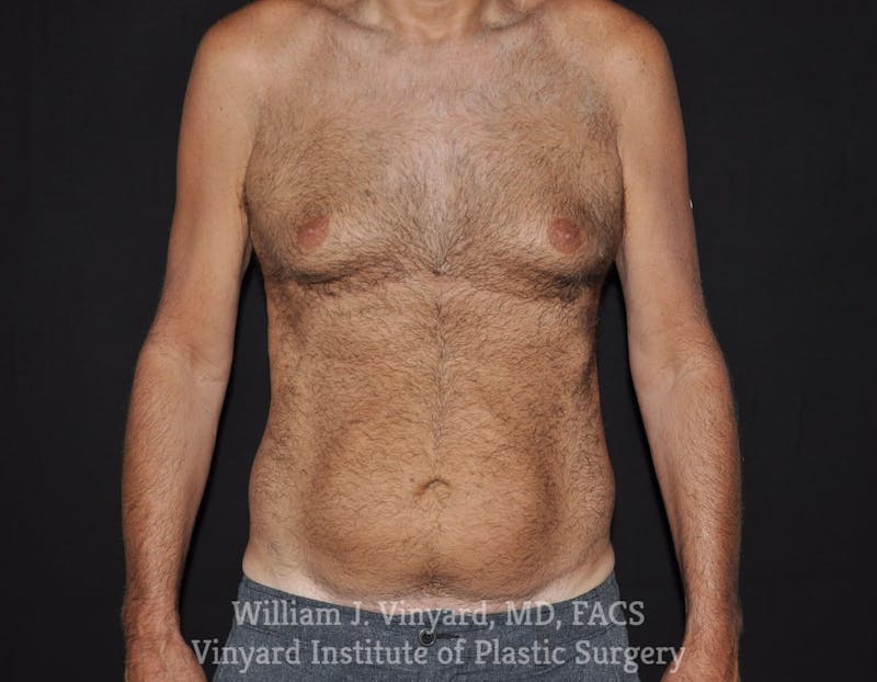 Liposuction Before & After Gallery - Patient 169754255 - Image 1
