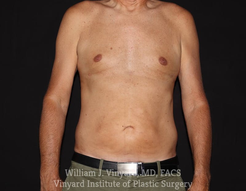 Liposuction Before & After Gallery - Patient 169754255 - Image 2