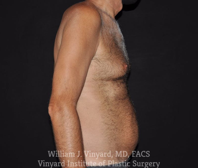 Liposuction Before & After Gallery - Patient 169754255 - Image 3