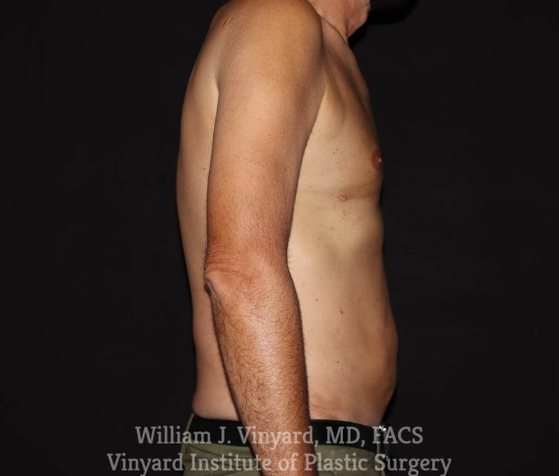 Liposuction Before & After Gallery - Patient 169754255 - Image 4