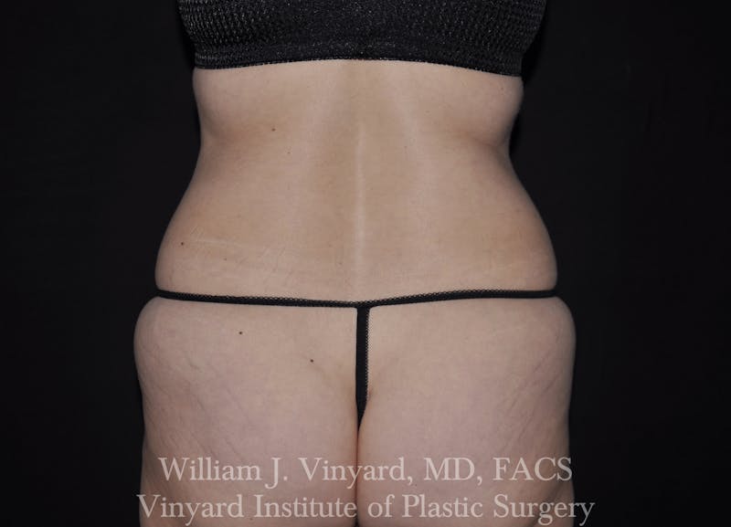 Liposuction Before & After Gallery - Patient 169754326 - Image 1