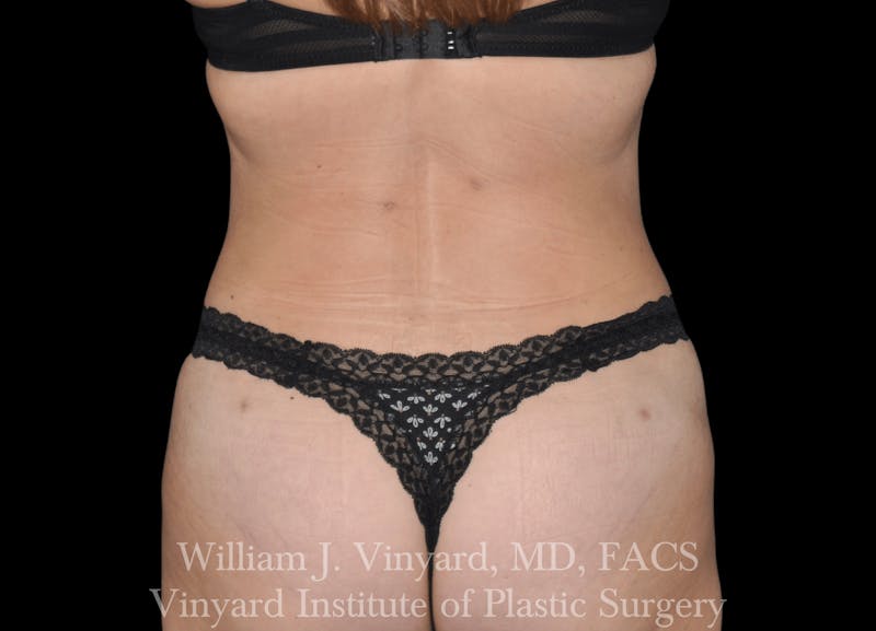 Liposuction Before & After Gallery - Patient 169754326 - Image 2