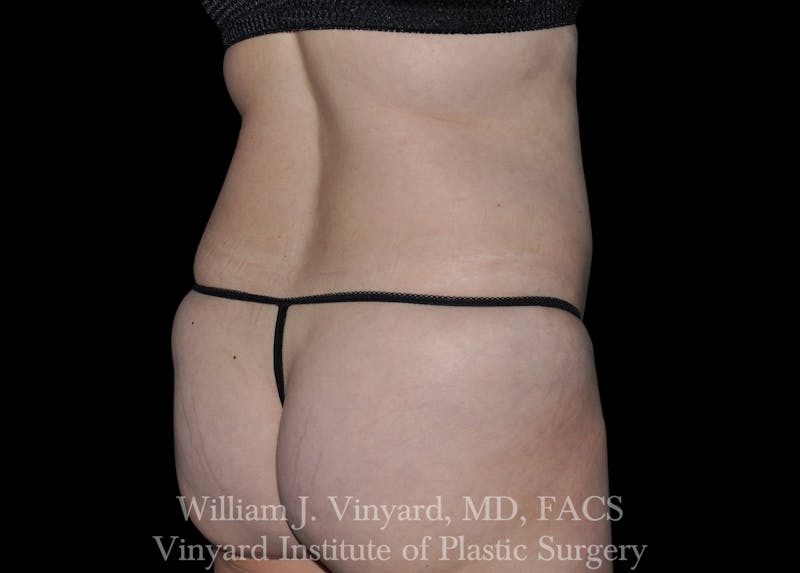 Liposuction Before & After Gallery - Patient 169754326 - Image 3