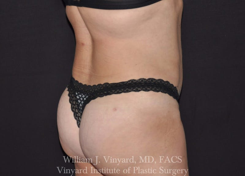 Liposuction Before & After Gallery - Patient 169754326 - Image 4