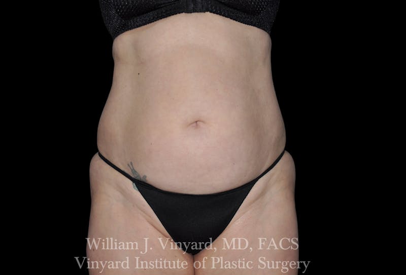 Liposuction Before & After Gallery - Patient 169754327 - Image 1
