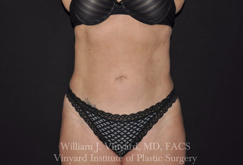 Liposuction Before & After Gallery - Patient 169754327 - Image 2