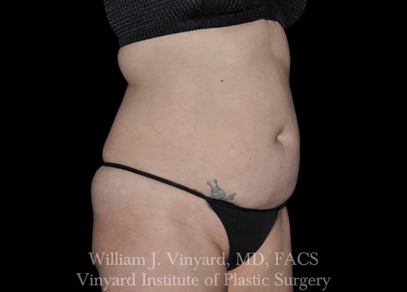 Liposuction Before & After Gallery - Patient 169754327 - Image 3