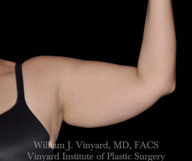 Liposuction Before & After Gallery - Patient 169754333 - Image 1