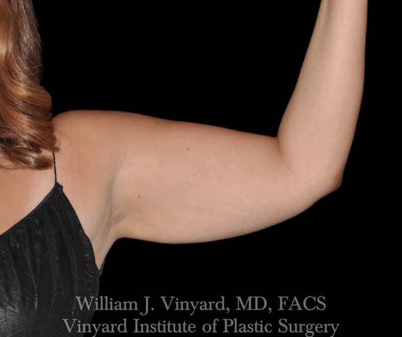 Liposuction Before & After Gallery - Patient 169754333 - Image 2