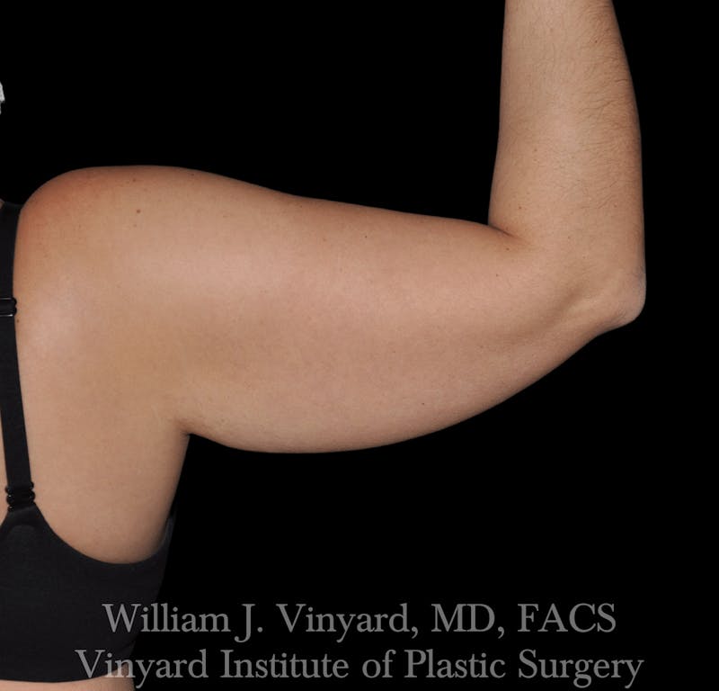 Liposuction Before & After Gallery - Patient 169754333 - Image 3