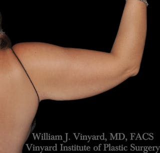Liposuction Before & After Gallery - Patient 169754333 - Image 4