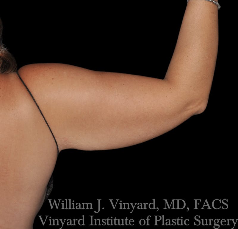 Liposuction Before & After Gallery - Patient 169754333 - Image 4