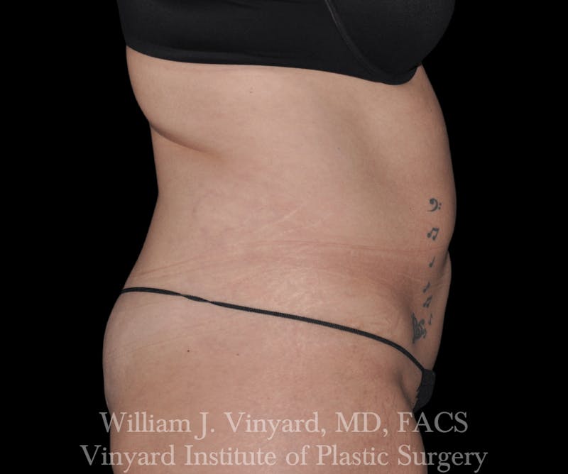 Liposuction Before & After Gallery - Patient 169754336 - Image 1