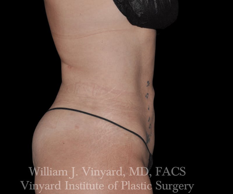 Liposuction Before & After Gallery - Patient 169754336 - Image 2