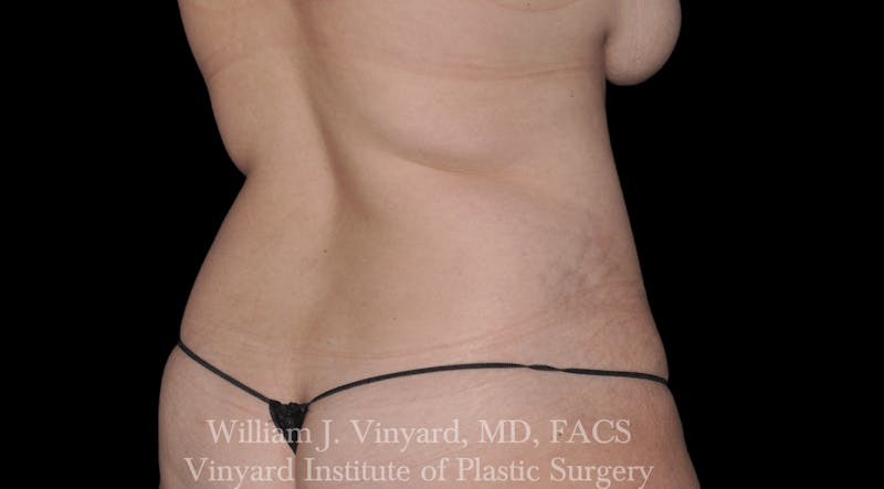Liposuction Before & After Gallery - Patient 169754336 - Image 3