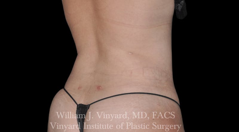 Liposuction Before & After Gallery - Patient 169754336 - Image 4
