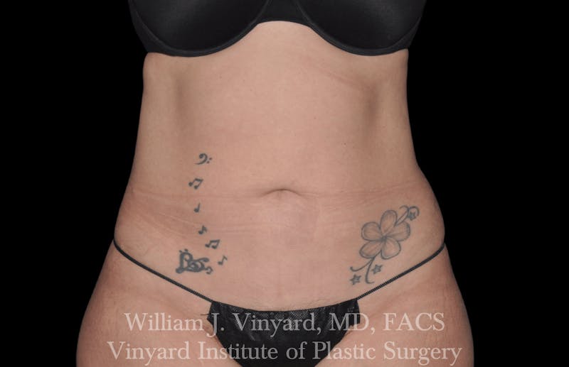 Liposuction Before & After Gallery - Patient 169754340 - Image 1