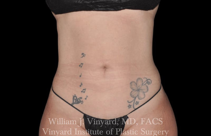 Liposuction Before & After Gallery - Patient 169754340 - Image 2