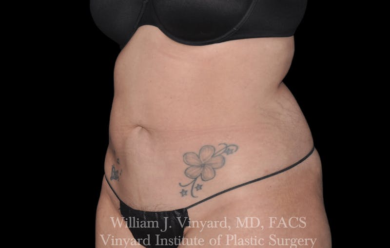 Liposuction Before & After Gallery - Patient 169754340 - Image 3