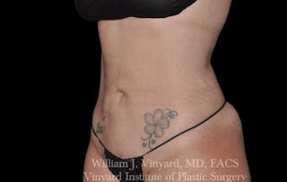 Liposuction Before & After Gallery - Patient 169754340 - Image 4