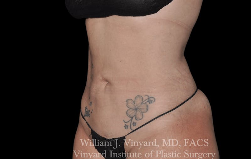 Liposuction Before & After Gallery - Patient 169754340 - Image 4