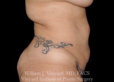 Liposuction Before & After Gallery - Patient 169754342 - Image 1
