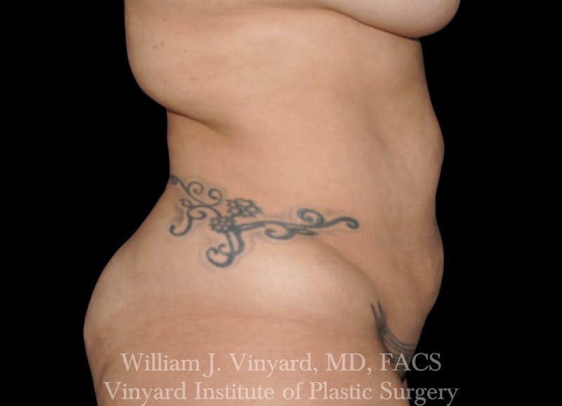 Liposuction Before & After Gallery - Patient 169754342 - Image 1