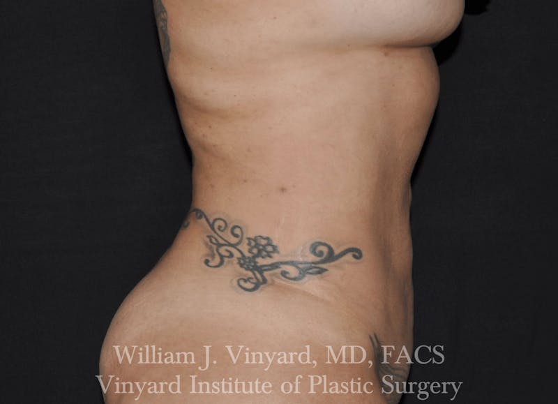 Liposuction Before & After Gallery - Patient 169754342 - Image 2