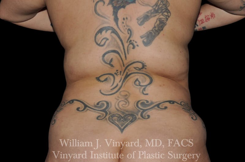 Liposuction Before & After Gallery - Patient 169754342 - Image 3