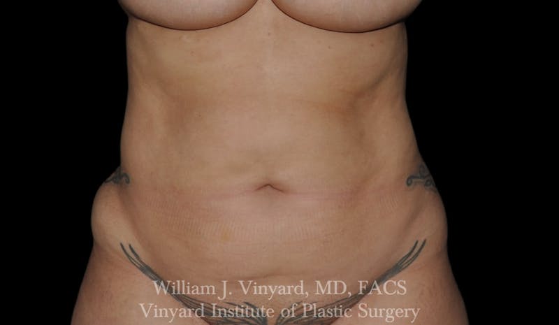 Liposuction Before & After Gallery - Patient 169754346 - Image 1