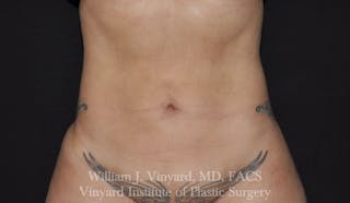 Liposuction Before & After Gallery - Patient 169754346 - Image 2