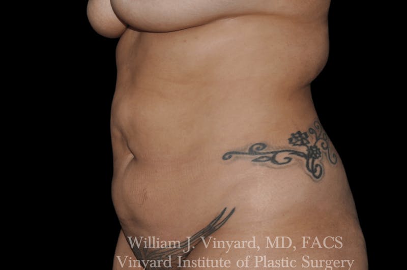 Liposuction Before & After Gallery - Patient 169754346 - Image 3