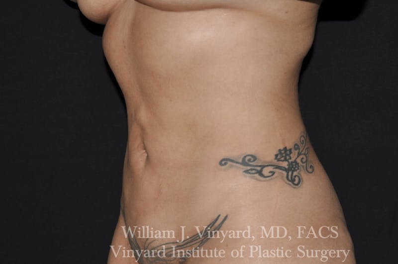 Liposuction Before & After Gallery - Patient 169754346 - Image 4
