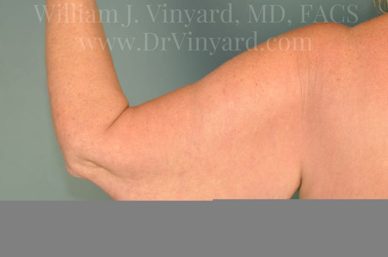 Arm Lift Before & After Gallery - Patient 169754907 - Image 1