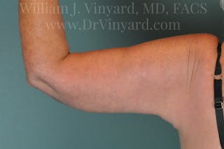 Arm Lift Before & After Gallery - Patient 169754907 - Image 2