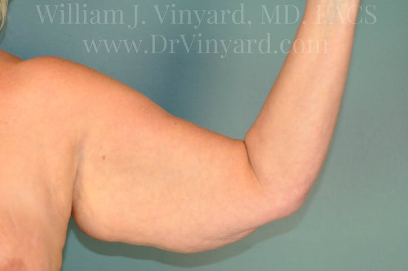 Arm Lift Before & After Gallery - Patient 169754907 - Image 3