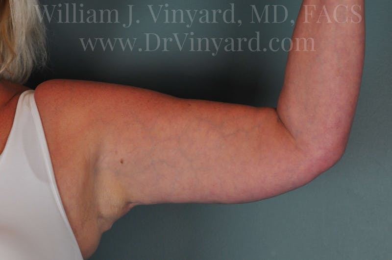 Arm Lift Before & After Gallery - Patient 169754907 - Image 4